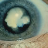 Cataracts Can Result From Eye Sports Injuries-NEI Picture