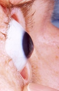 Kerataconus in the Human Eye