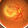 Macular Degneration Retina Disease 