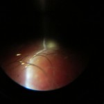  Conjunctival lymphangiectasia 
