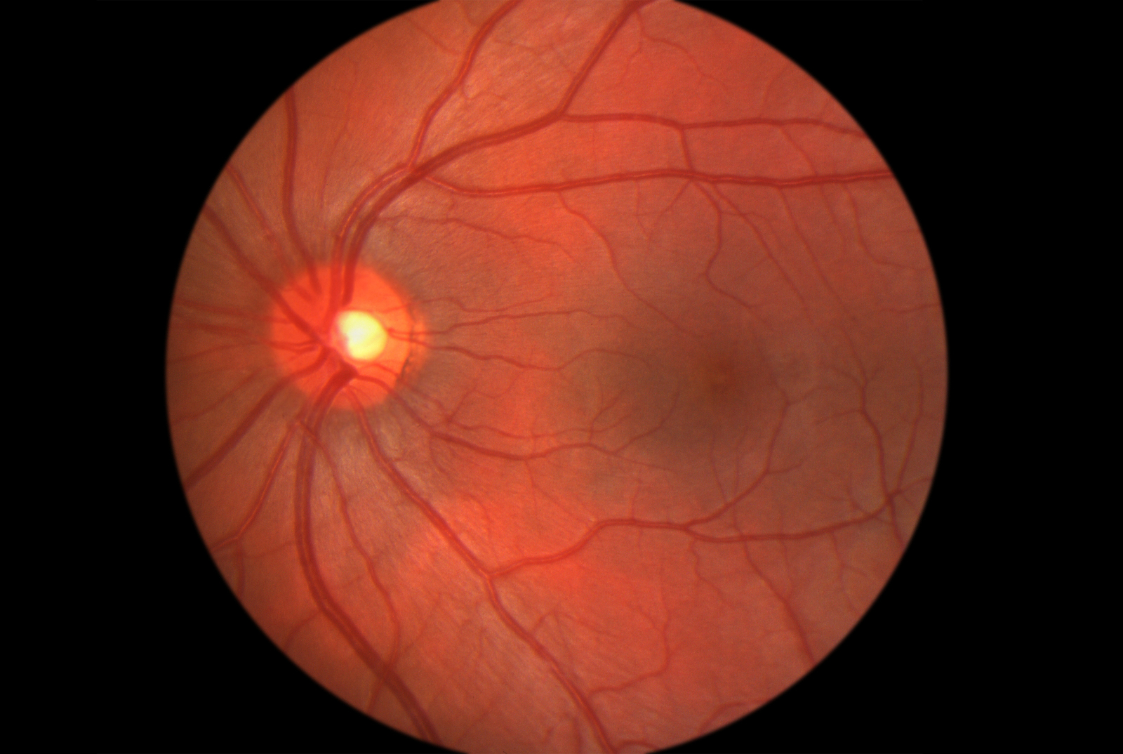 retina after pupil dilation drops